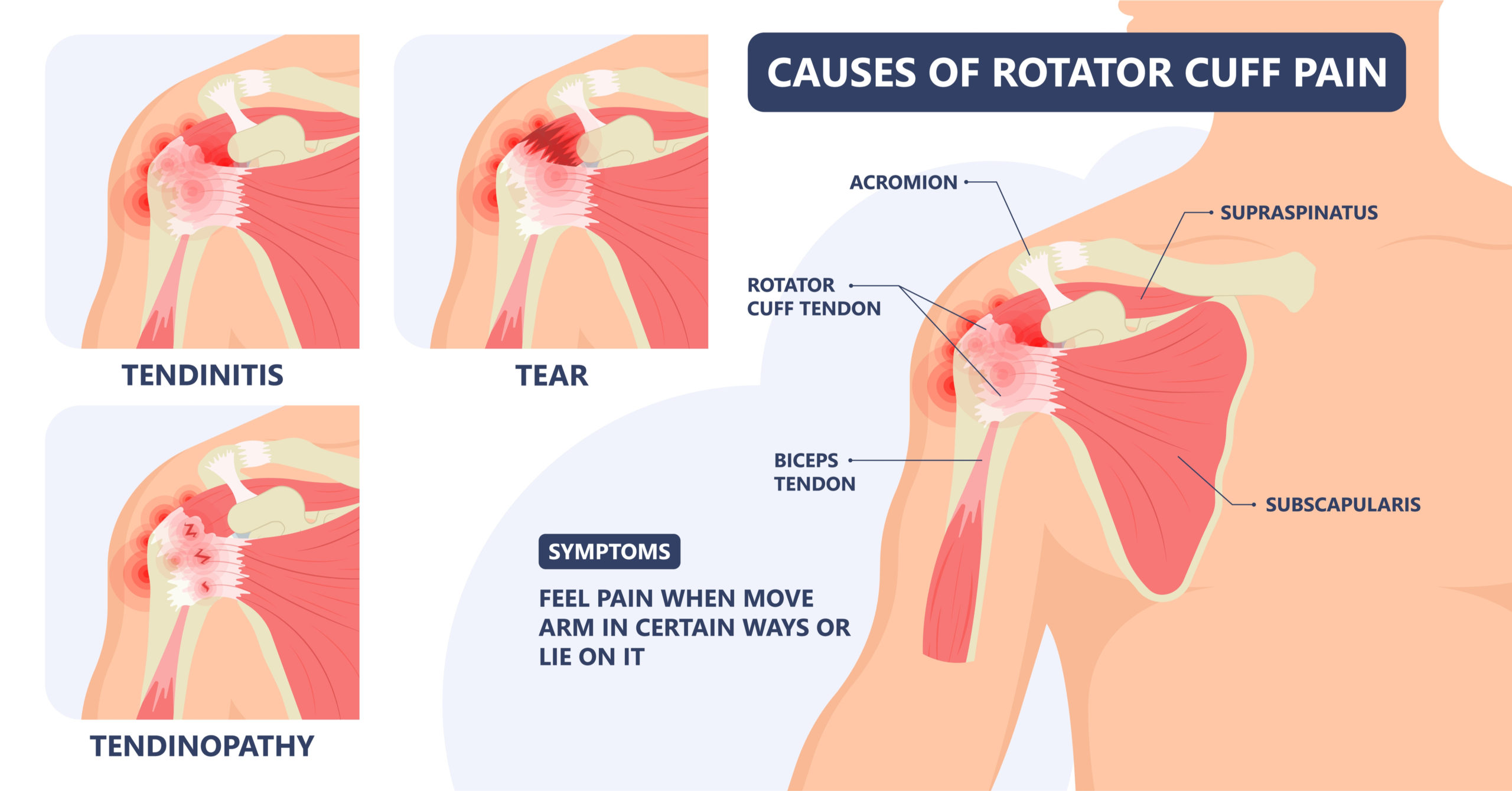 shoulder-pain-dr-matty-wong-chiropractor-excel-medical-group